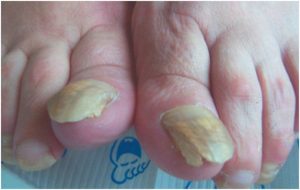 kalknagel saschas pedicurepraktijk heerhugowaard