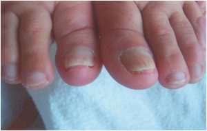 nagelherstel saschas pedicurepraktijk heerhugowaard