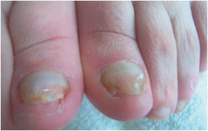 schimmelnagel saschas pedicurepraktijk heerhugowaard